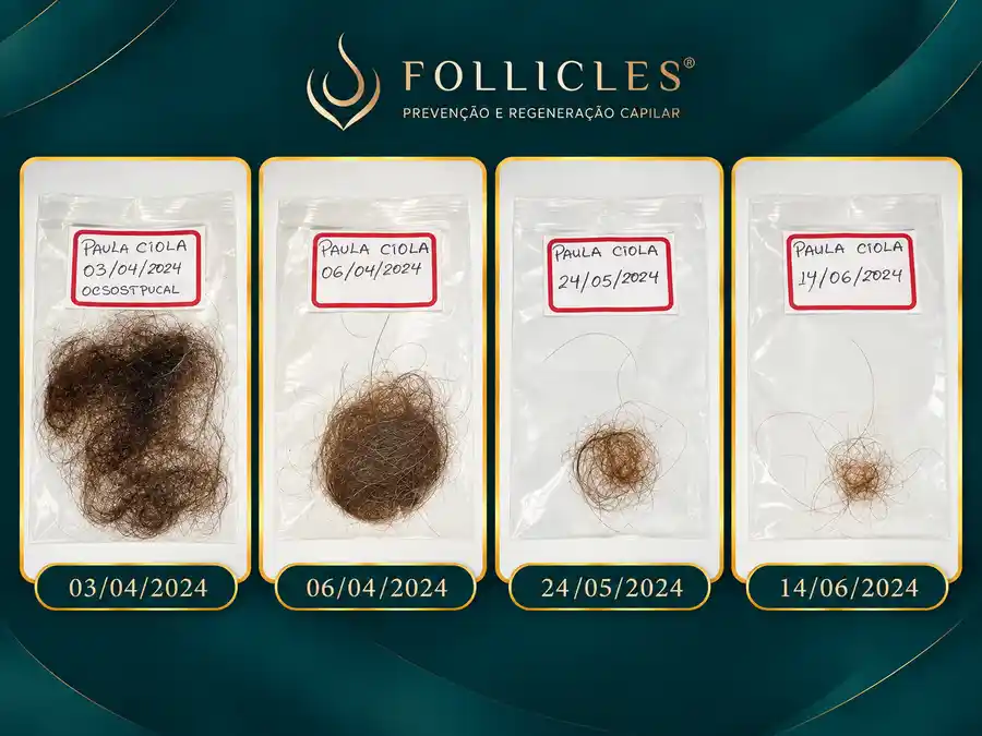 Resultado de queda capilar — paciente da Clínica Follicles, imagem 3